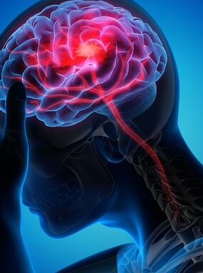 migraine